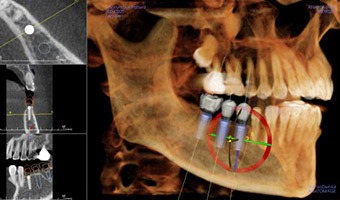 X-ray image showing three titanium tooth implants in the jaw. 