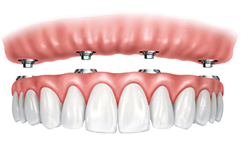 Model of implant supported dentures.