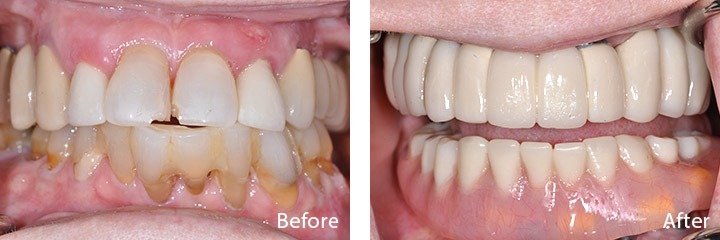 New teeth in one day patient