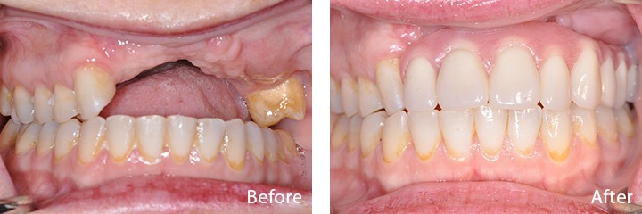 New teeth in one day patient