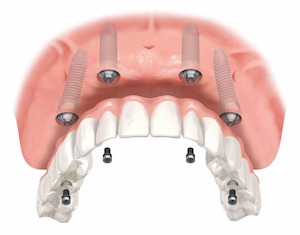 Diagram of the all on four teeth procedure, showing the screws in the gums of the primary teeth.