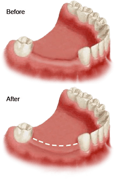 Before and after of bone loss between teeth due to tooth loss. 
