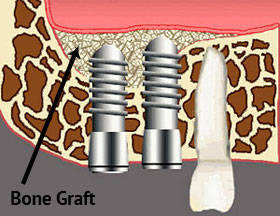 Diagram of grafted bone area in which dental implants are placed.