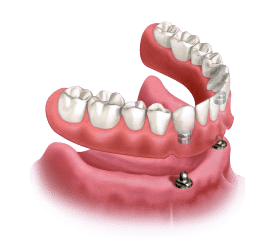 Implant supported dentures being snapped onto lower gum line.