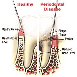 Ask a Periodontist - How Can Gum Disease Harm Your Teeth and Jawbone?