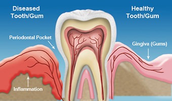 Gum Disease Treatment