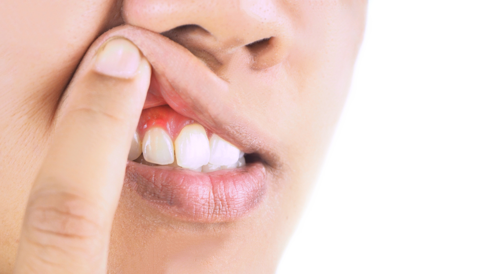 shutterstock 1335130334 woman with inflammed gums