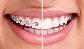 Before and after photo of a smile with and without braces.