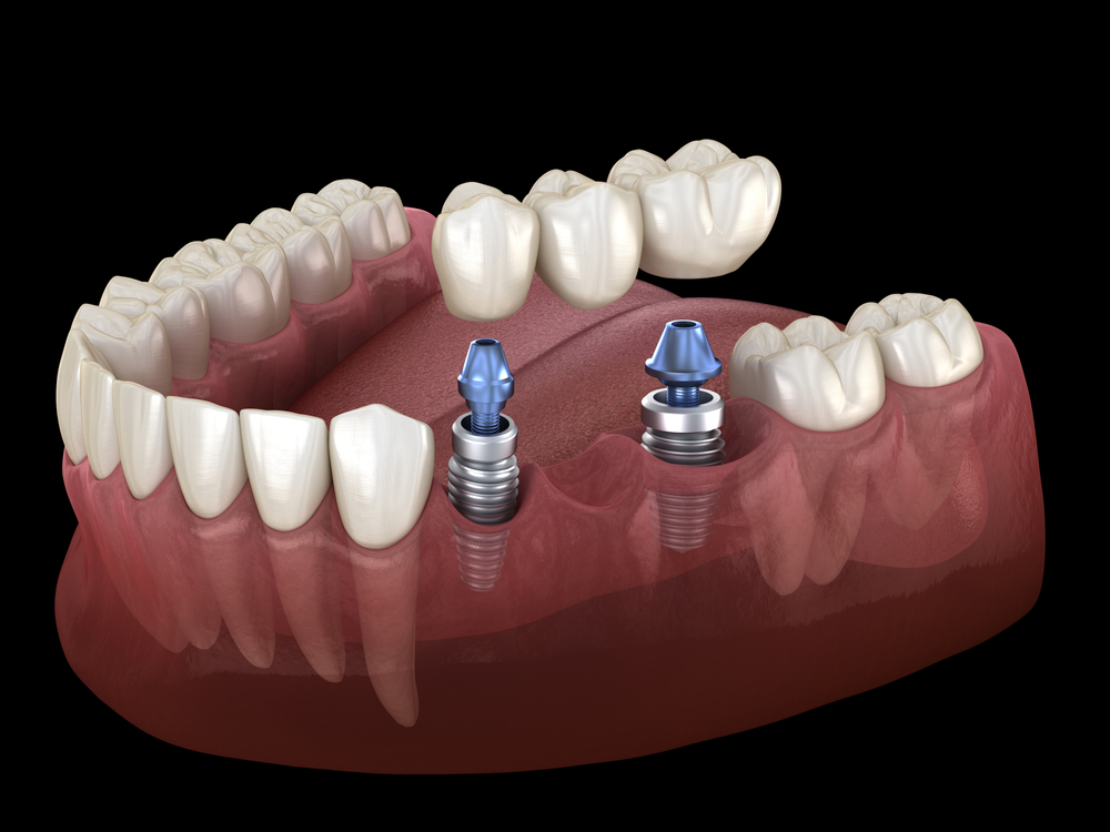 implant-supported bridge