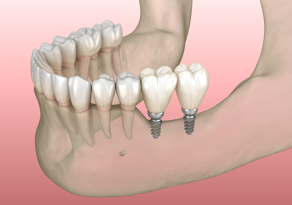 bone loss and dental implants