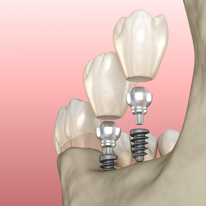 "Mini dental implants are smaller versions of traditional dental implants, typically ranging from two mm to 3.5 mm in diameter." mini dental implants