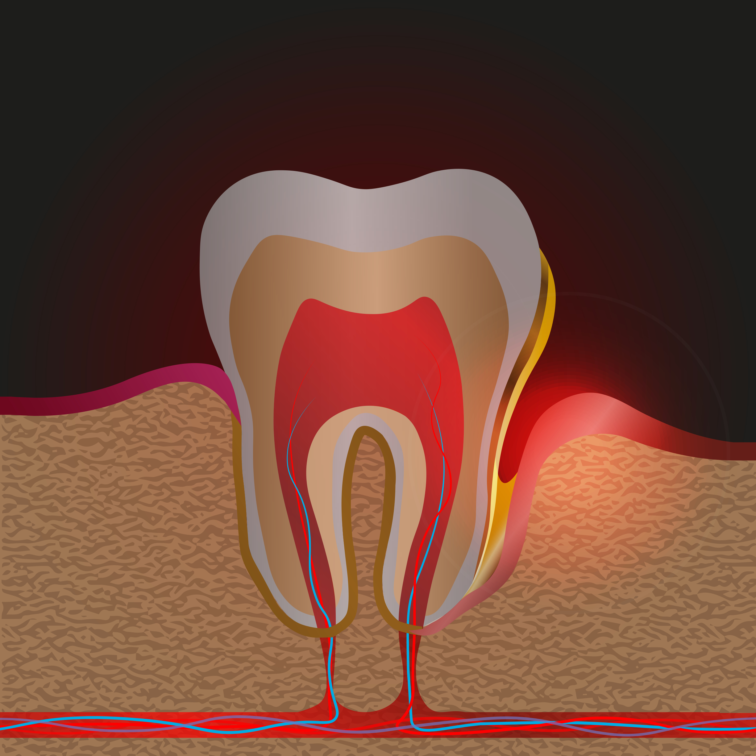 Gum Disease creates pockets near roots of teeth