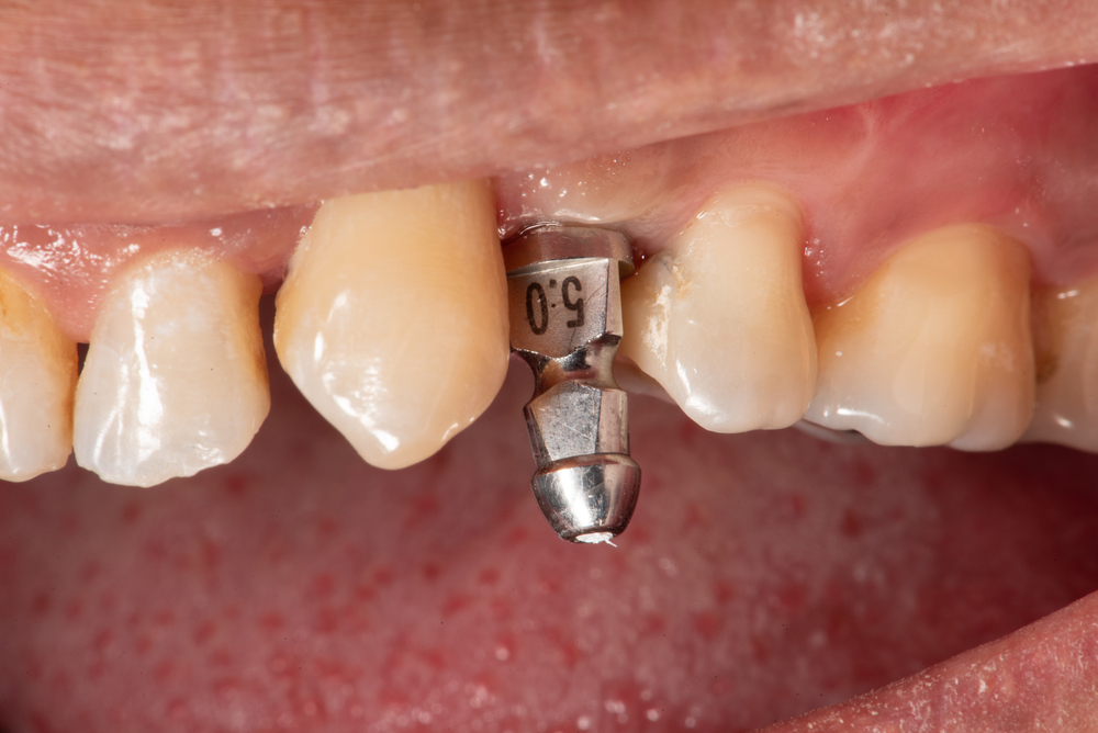 Impression,Coping,In,The,Mouth single implant in mouth