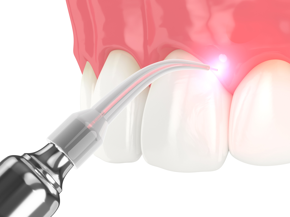 3d,Render,Of,Dental,Diode,Laser,Used,To,Treat,Gums. lanap for gum disease