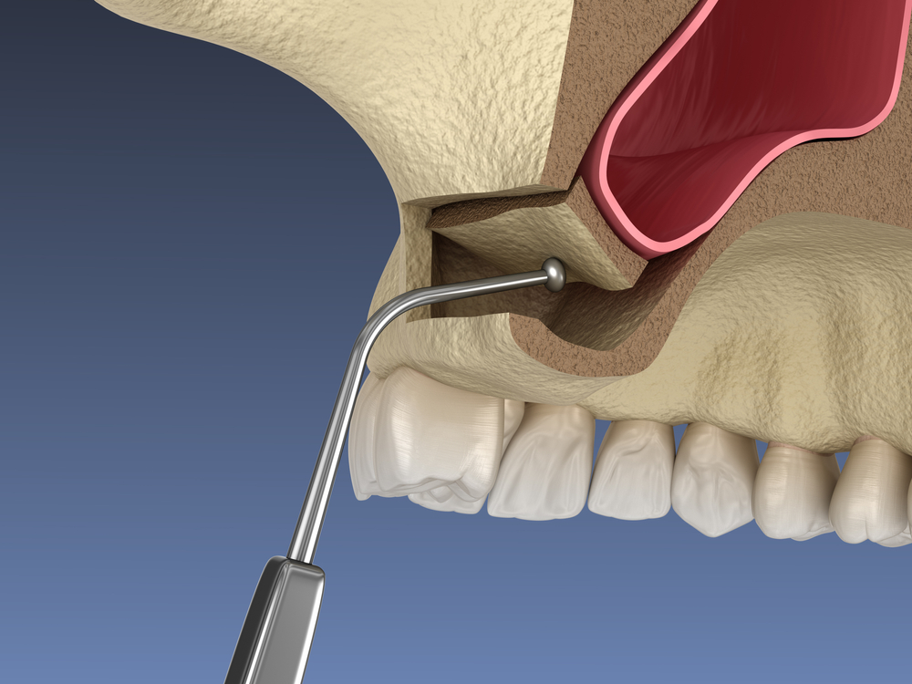 Sinus,Lift,Surgery, ,Moving,Sinus,Membrane.,3d,Illustration Sinus,Lift,Surgery, ,Moving,Sinus,Membrane.,3d,Illustration