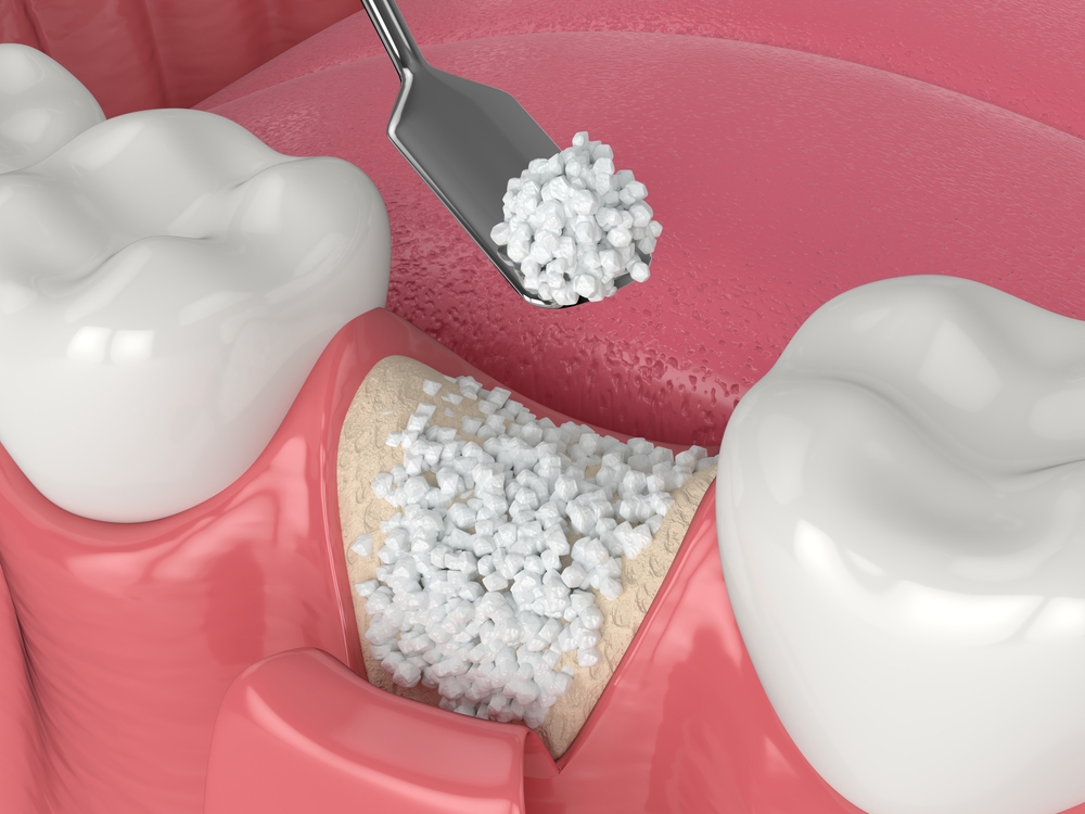 3d,Render,Of,Dental,Bone,Grafting,With,Bone,Biomaterial,Application ridge augmentation