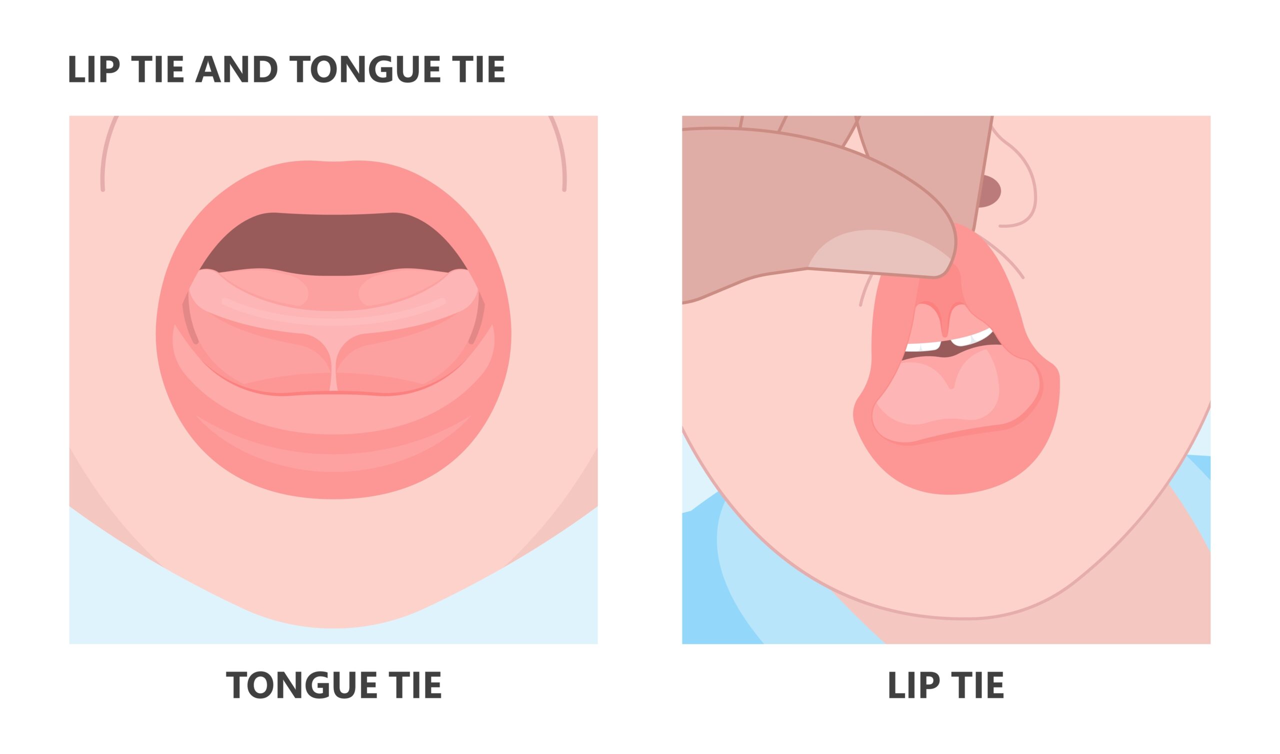 lip tie and tongue tie