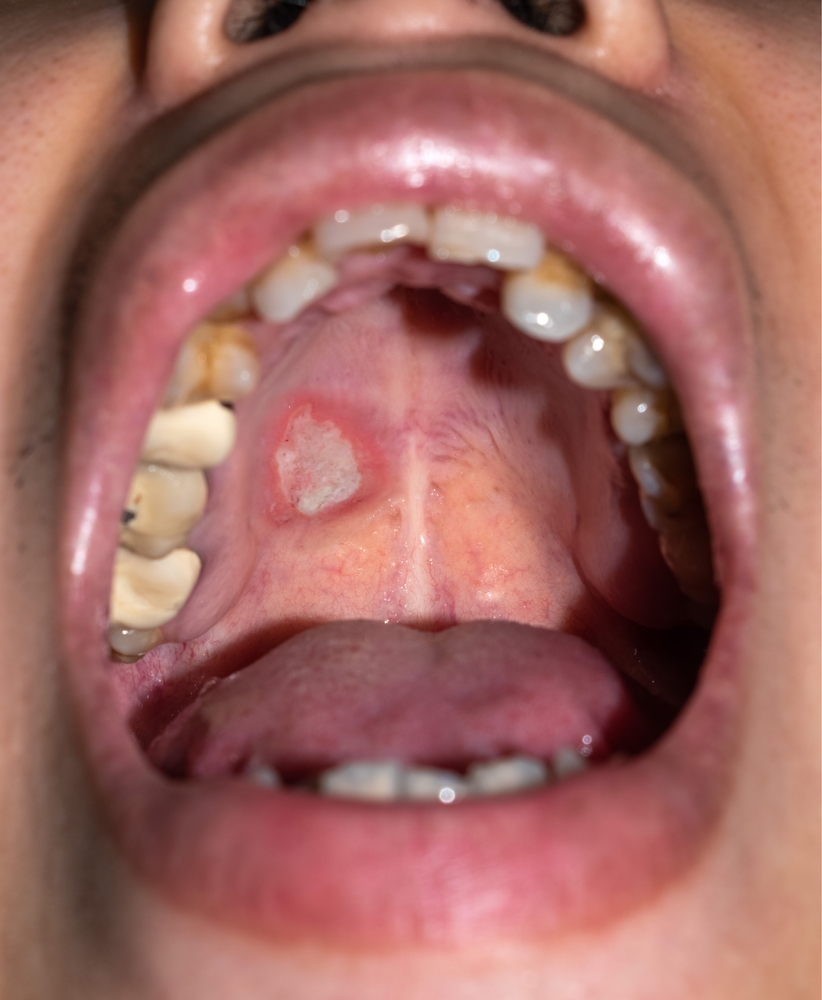 mouth sore could indicate oral cancer