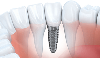 Diagram of a titanium implant being screwed into a mouth.
