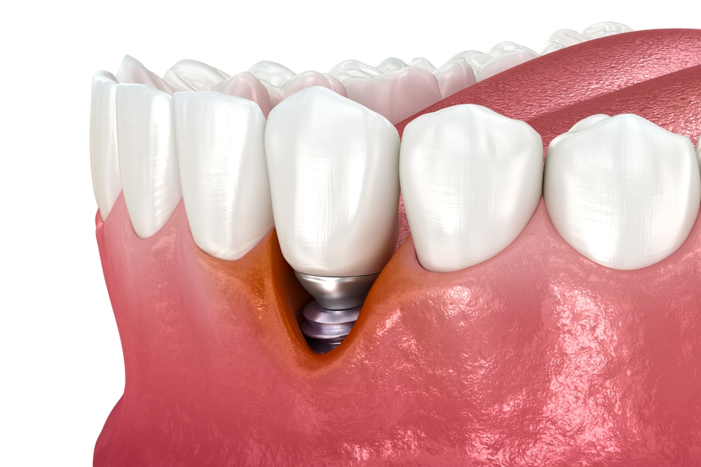 Peri implantitis with gum recession