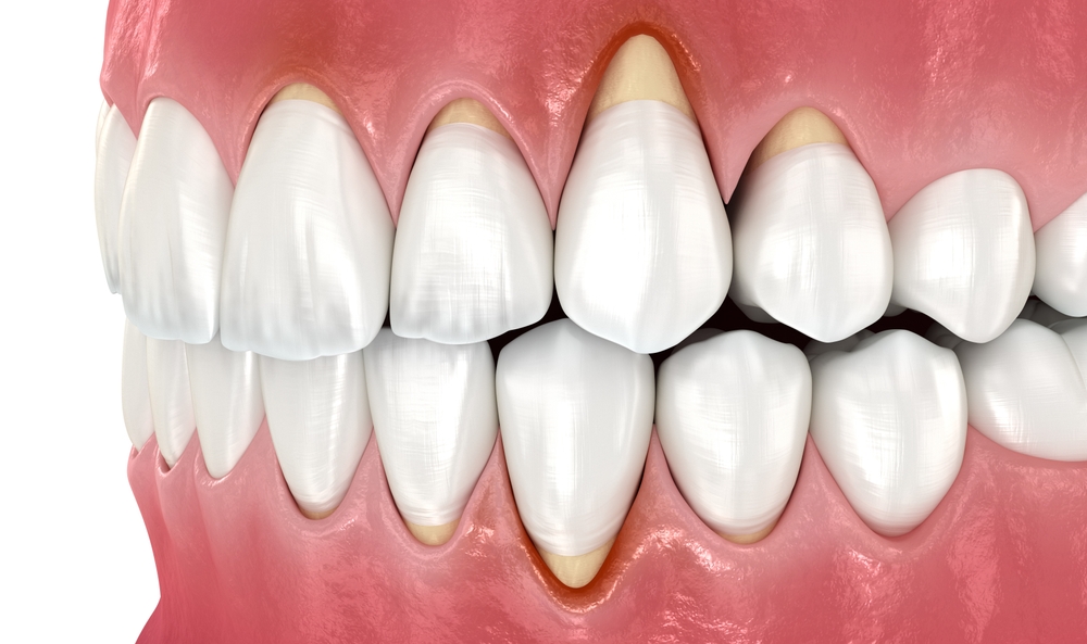 shutterstock 2283993607 (1) gum recession