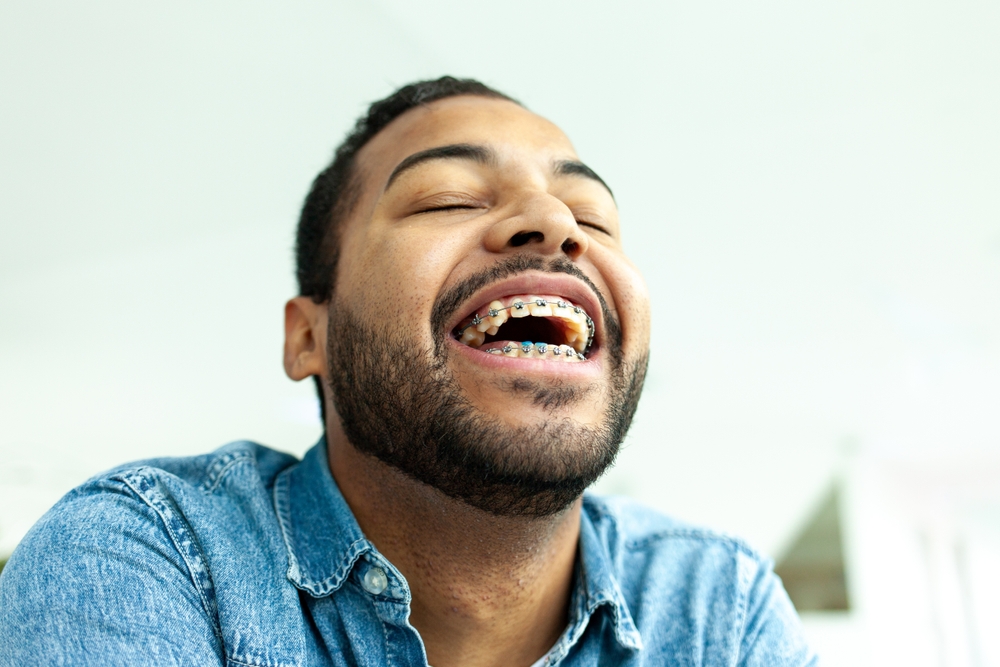 African,American,Man,With,Braces,Smiles,And,Covers,His,Smile