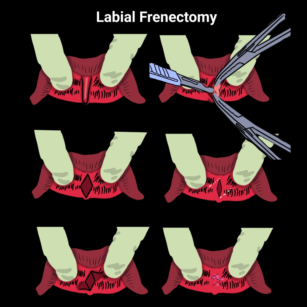 labial frenectomy step by step
