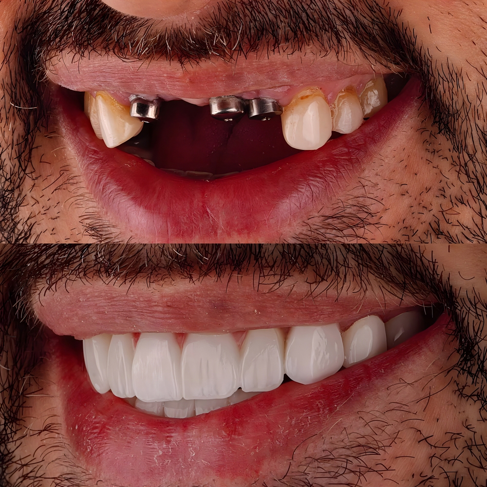 New,Smile,Design,With,Intra bone,Dental,Implants,In,Dentistry.,Porcelain before and after restoration added to dental implants in mouth