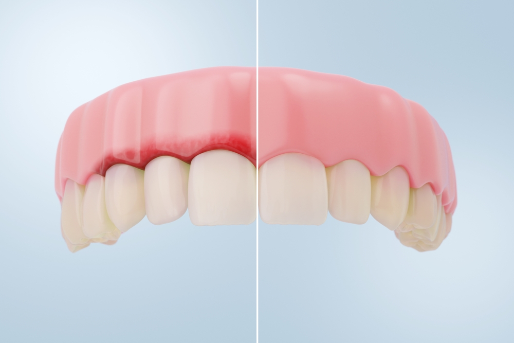 shutterstock 2545752039 bleeding gums before and after gum disease treatment