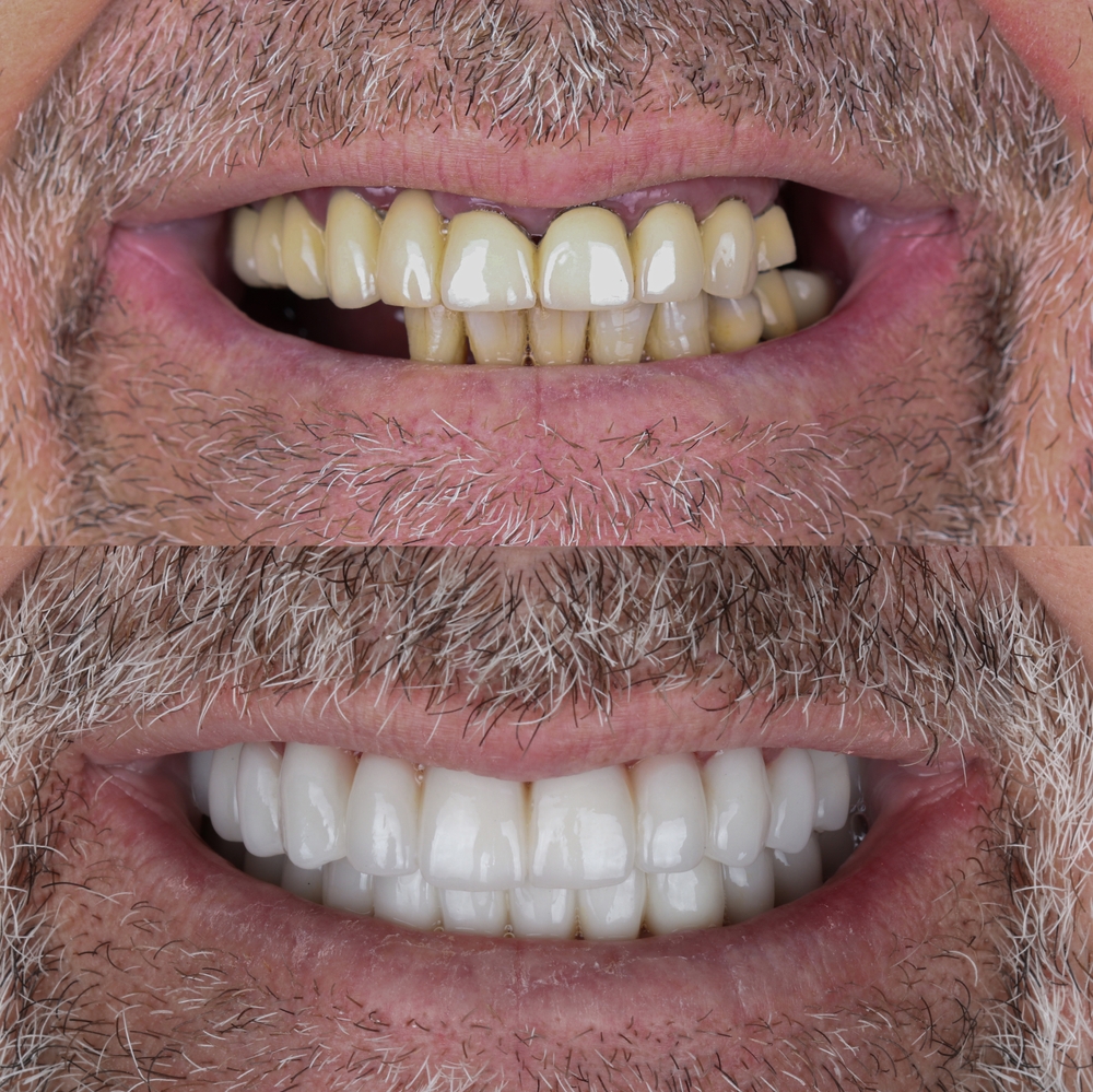 man with tooth and bone loss