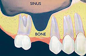 Bone loss under sinus cavity that will require a sinus lift for placement of dental implant.