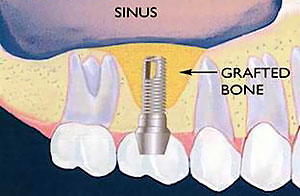 New bone growth after Piezoelectric surgery device grafted the bone area.